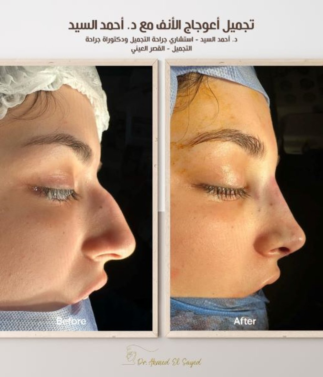 Resultados de rinoplastia antes y después por Dr. Ahmed El Sayed, corrección nasal