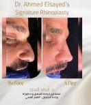 نتائج عملية تجميل الأنف قبل وبعد مع د. أحمد السيد، إعادة تشكيل الأنف بمظهر طبيعي