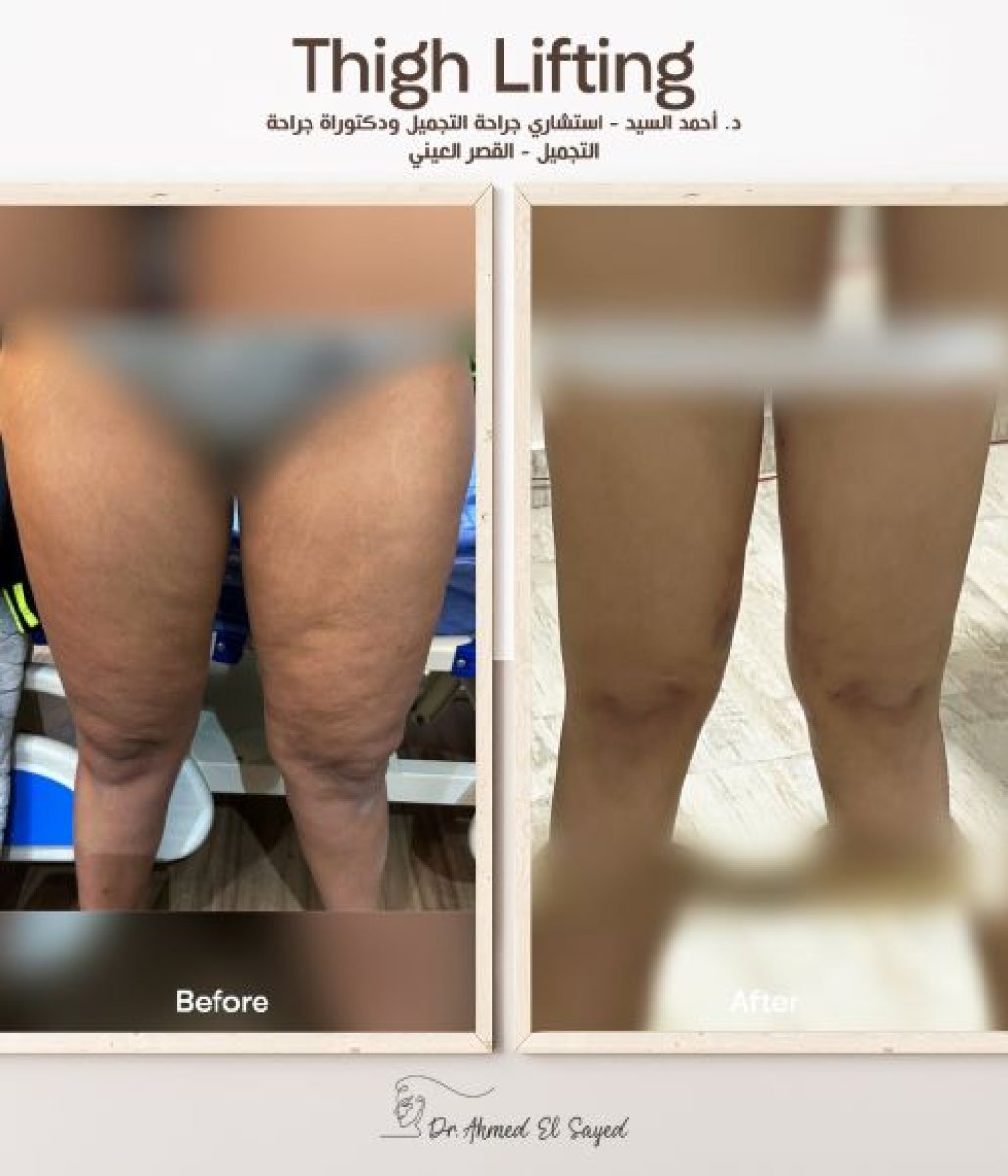 Resultados de lifting de muslos antes y después por Dr. Ahmed El Sayed – contorno mejorado