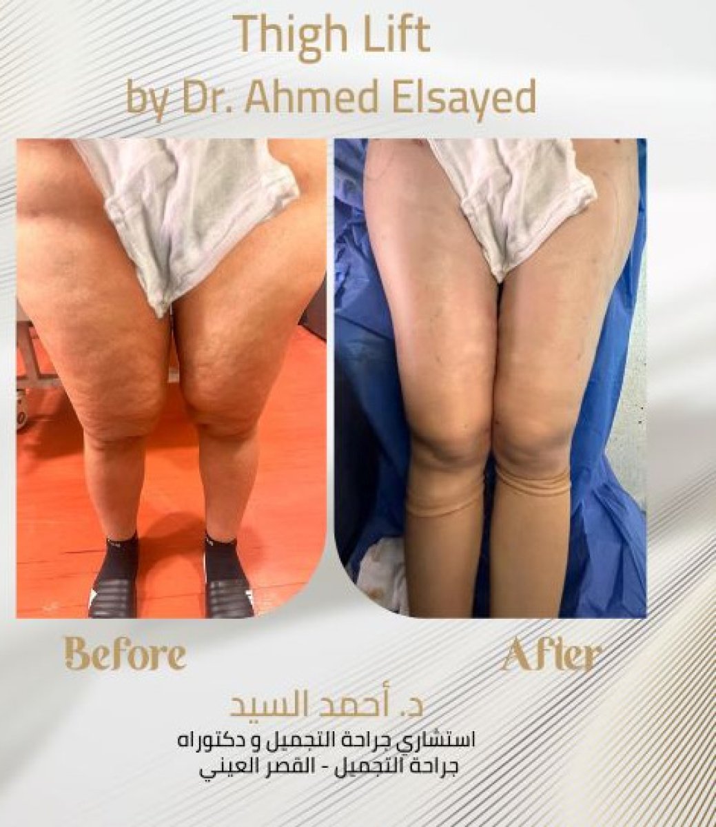 Resultados de lifting de muslos antes y después por el Dr. Ahmed Elsayed – muslos más lisos