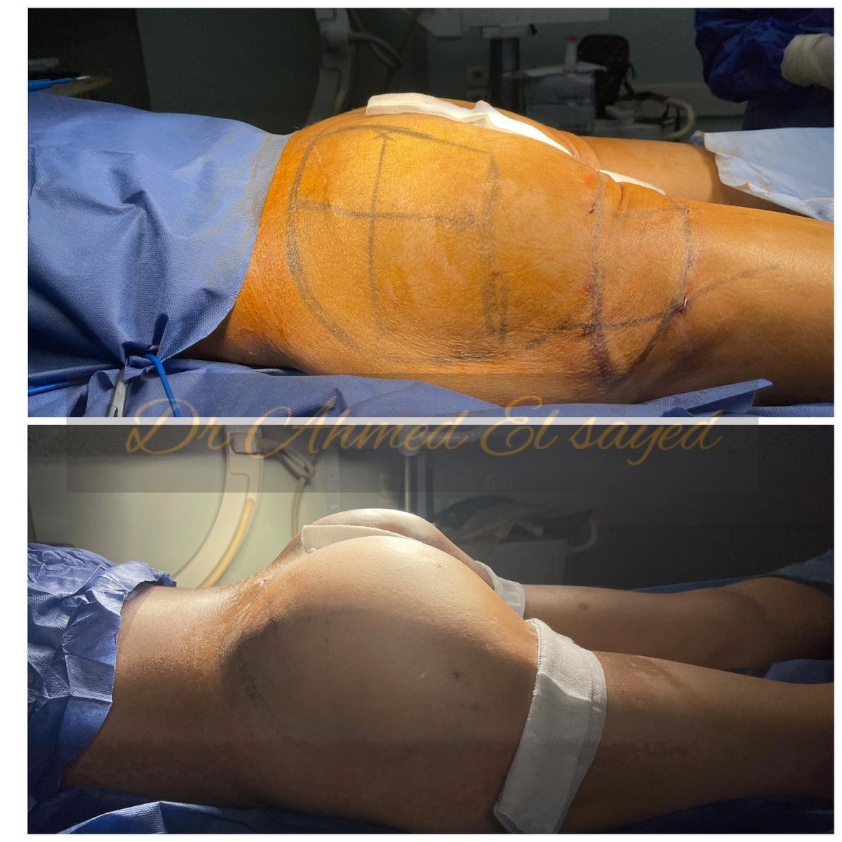 Resultados antes y después de Brazilian Butt Lift – glúteos mejor contorneados tras el procedimiento