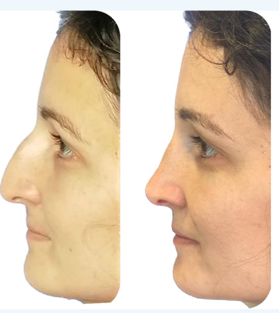 نتائج تجميل الأنف قبل وبعد – إعادة تشكيل الأنف وتحسين التناسق الجانبي