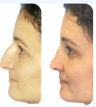نتائج تجميل الأنف قبل وبعد – إعادة تشكيل الأنف وتحسين التناسق الجانبي