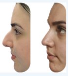 نتائج عملية تجميل الأنف قبل وبعد، إعادة تشكيل الأنف وتحسين المظهر الجانبي