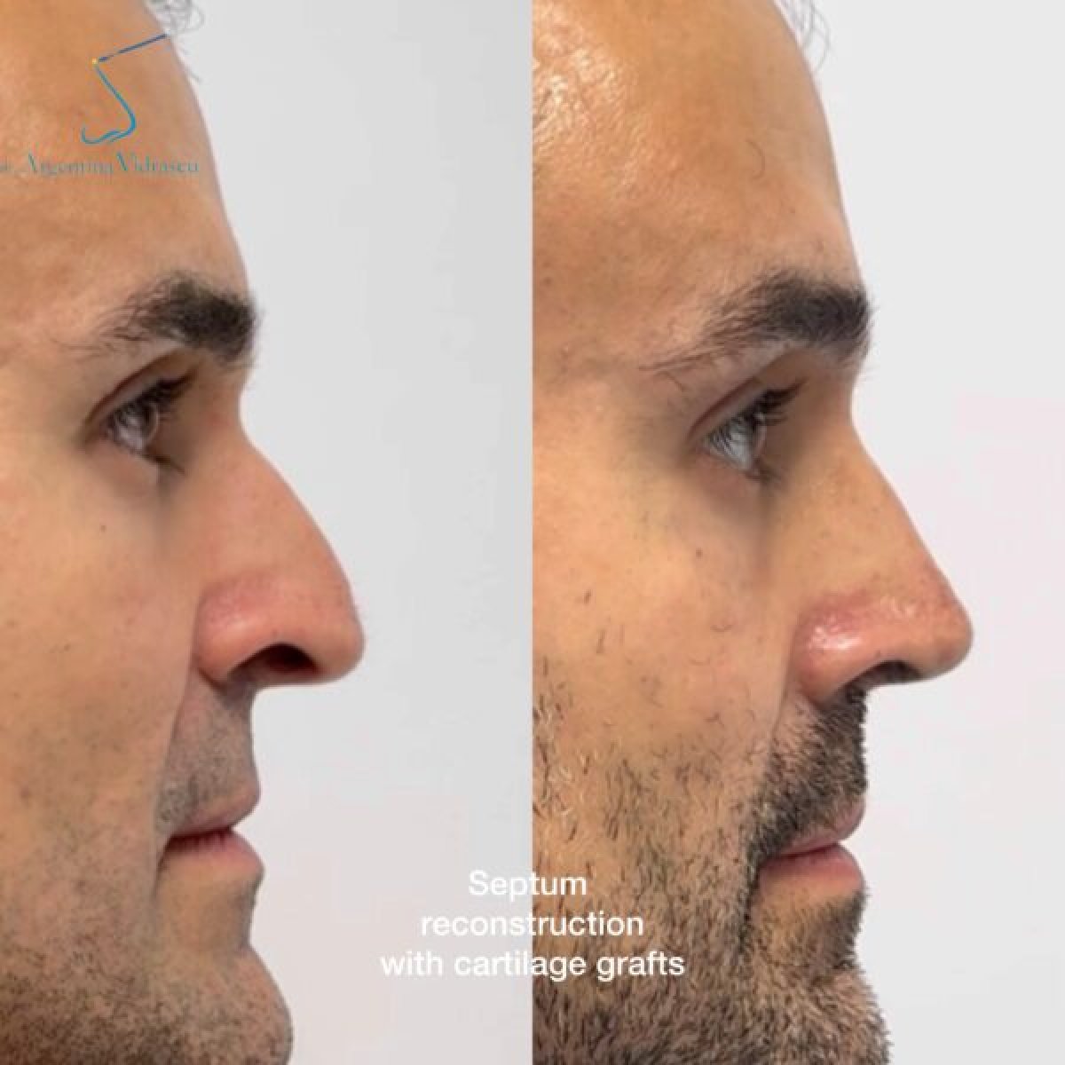 Antes y después de septoplastia con injertos de cartílago, resultado de perfil nasal mejorado