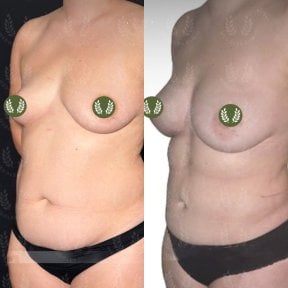 before-after photo 360-liposuction