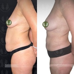 before-after photo 360-liposuction