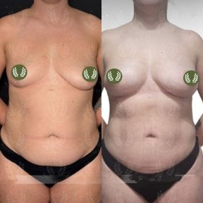 before-after photo 360-liposuction