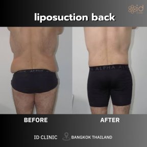 before-after photo vaser-liposuction