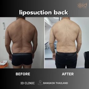 before-after photo vaser-liposuction