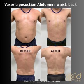 before-after photo vaser-liposuction