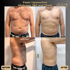 before-after photo vaser-liposuction