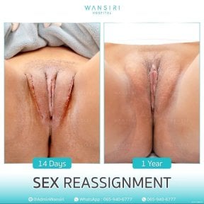 before-after photo sex-reassignment-surgery