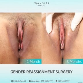 before-after photo sex-reassignment-surgery