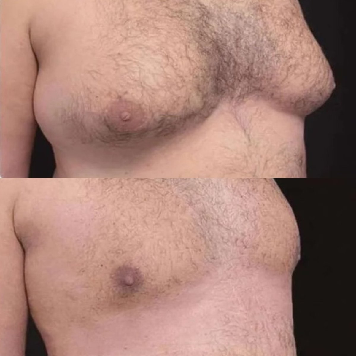 Resultados antes y después de cirugía de ginecomastia en ElGamal Clinic, contorno masculino