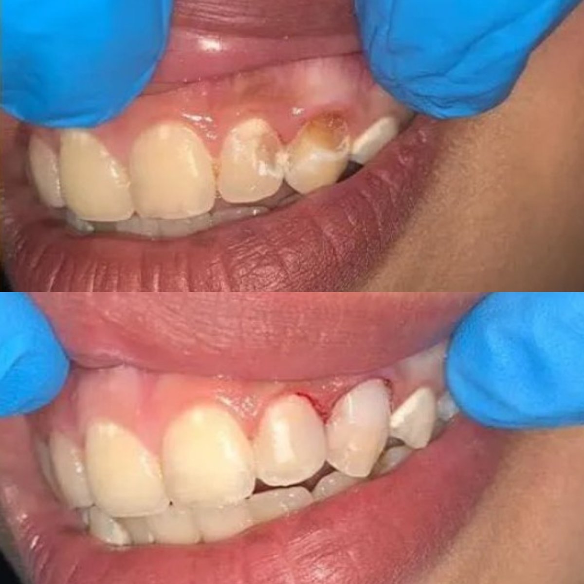 Resultados de antes y después de bonding dental en ElGamal Clinic para dientes dañados y manchados