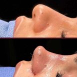 نتائج عملية تجميل الأنف قبل وبعد في عيادة ElGamal، تحسين شكل الأنف