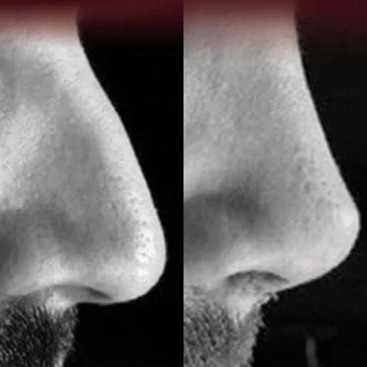 Resultados de rinoplastia antes y después en ElGamal Clinic, mejora de la forma nasal