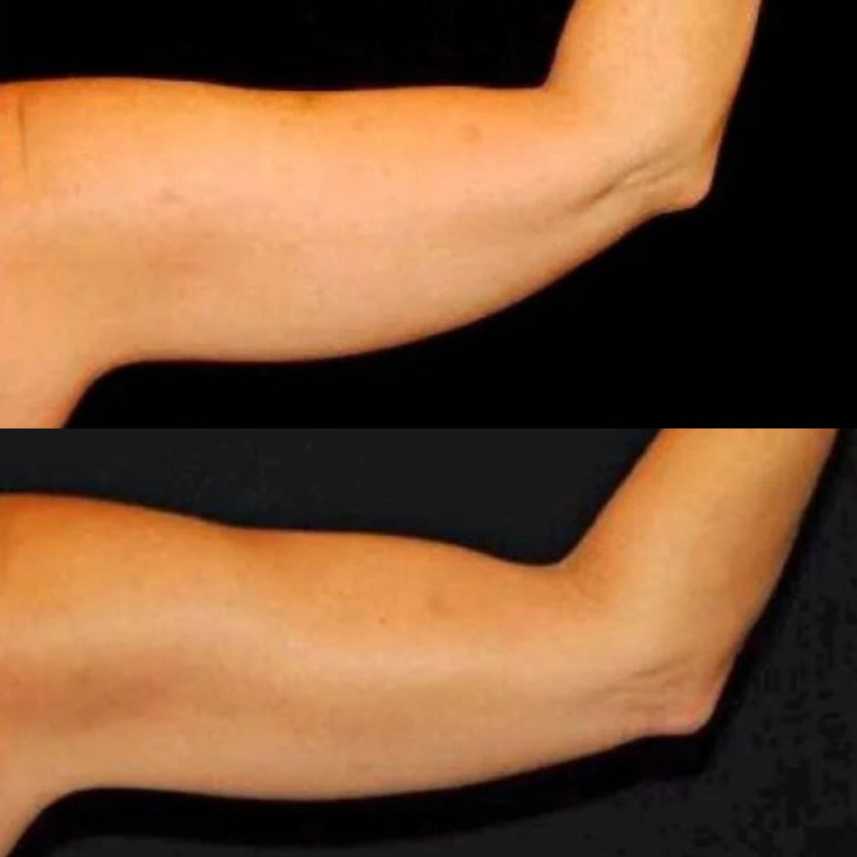 Resultados de lifting de brazos (braquioplastia) antes y después en ElGamal Clinic
