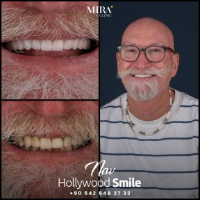 before-after photo dental-implant