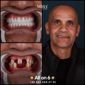 before-after photo dental-implant