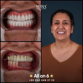 before-after photo dental-implant