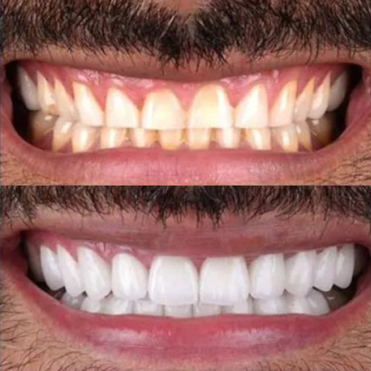 Resultados de blanqueamiento dental antes y después en ElGamal Clinic – sonrisa más blanca