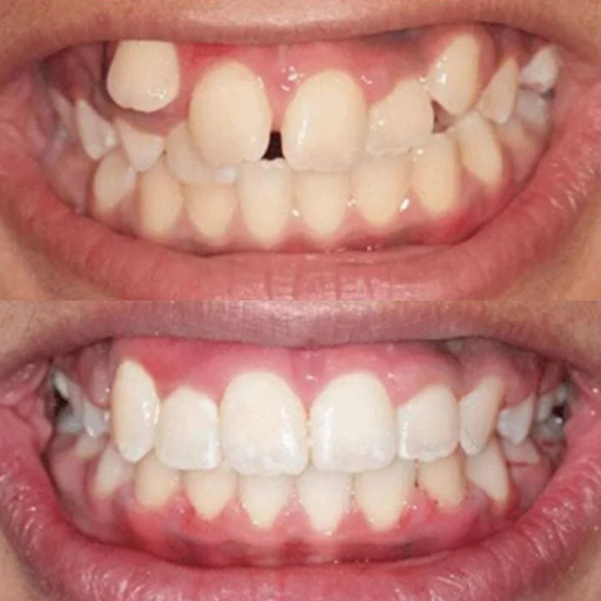 Resultados antes y después de Invisalign en ElGamal Clinic: dientes más rectos y sonrisa mejorada