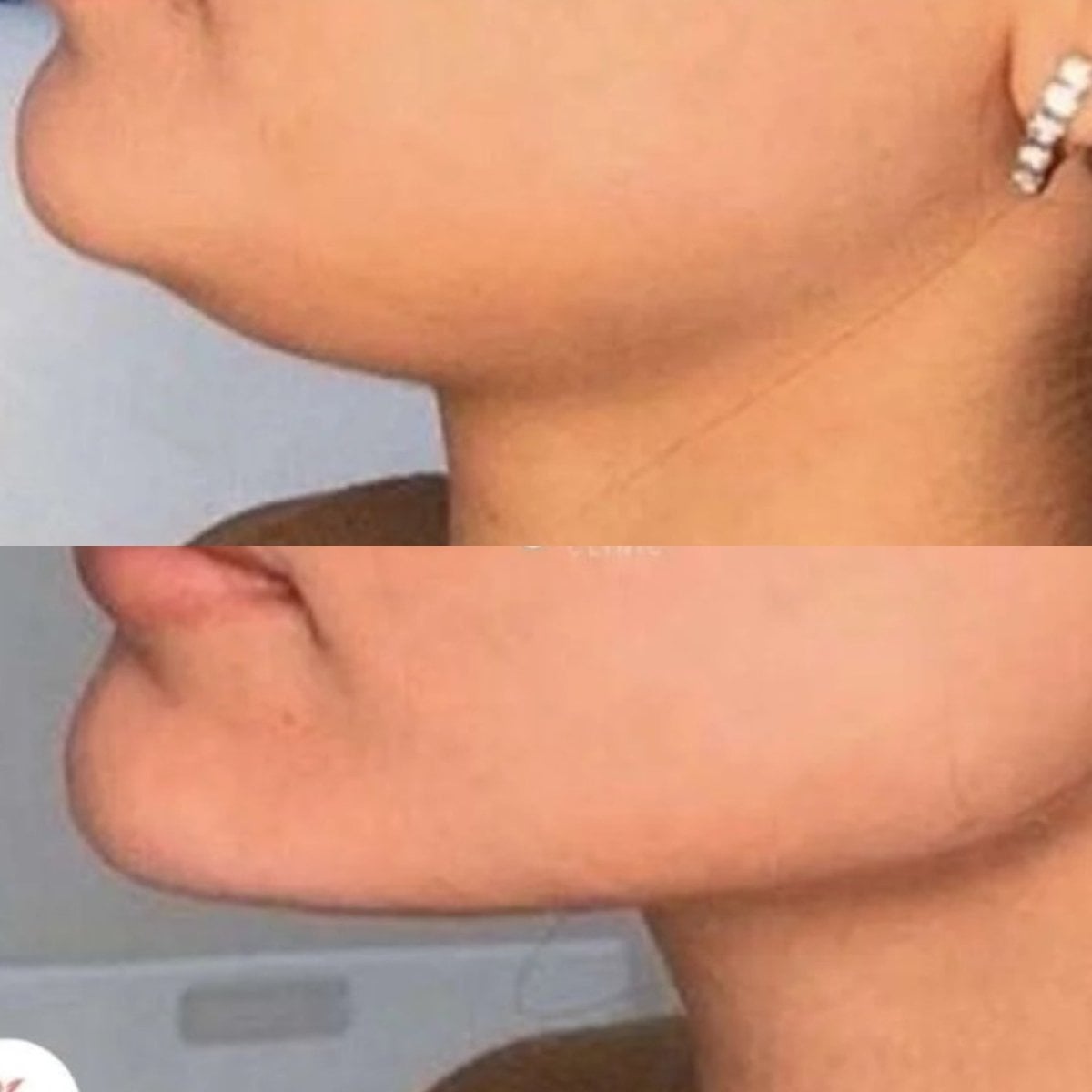 Resultados antes y después de lifting de cuello en ElGamal Clinic, mejor contorno mandibular