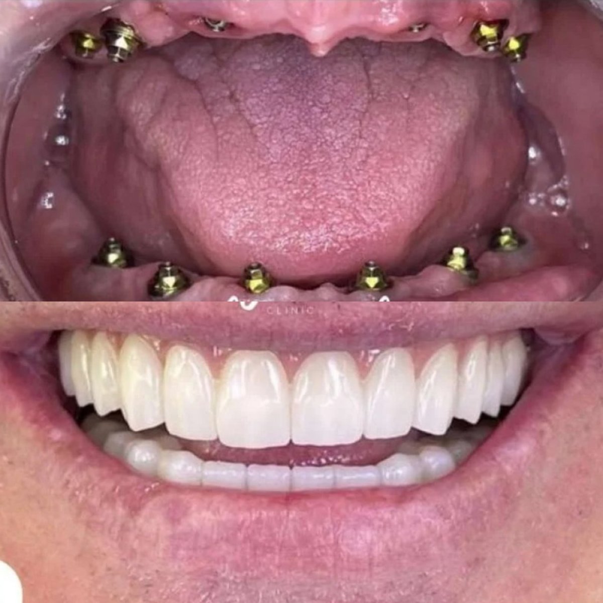 Antes y después de implante dental con corona en ElGamal Clinic, restauración total de la sonrisa