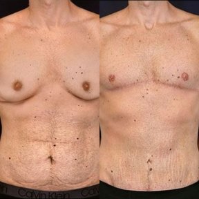 before-after photo gynecomastia-surgery