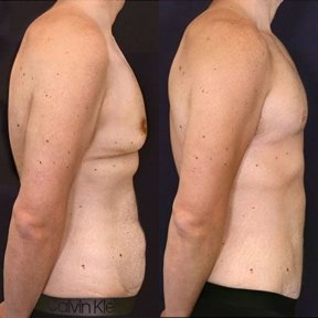 before-after photo gynecomastia-surgery