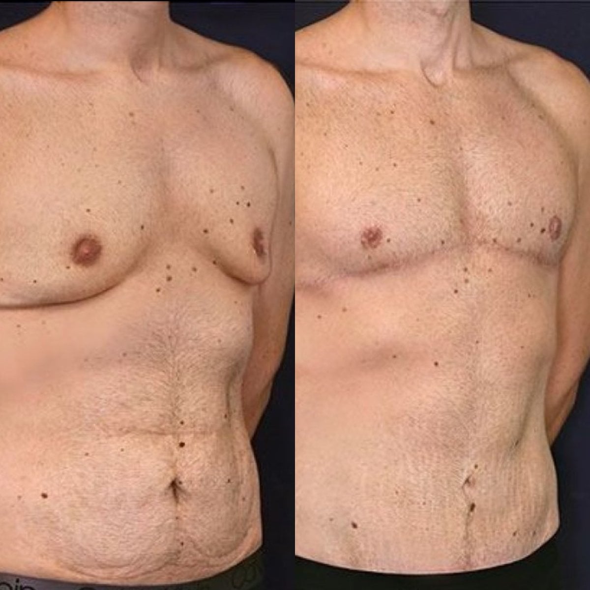 نتائج قبل وبعد جراحة التثدي في عيادة Dr. Alexandro Aguilera - Plastic Surgery