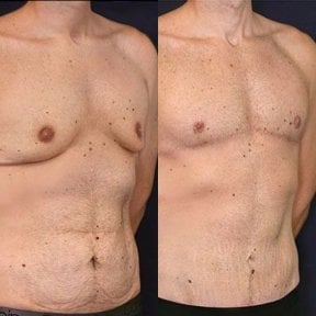 before-after photo gynecomastia-surgery