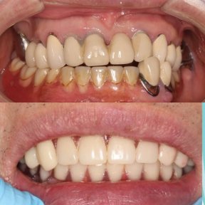 before-after photo dental-implant