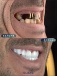 Before and after dental implant results at SUAVE DENTAL CLINIC – restored smile transformation