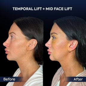 before-after photo endoscopic-facelift