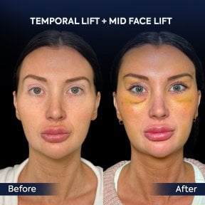 before-after photo endoscopic-facelift