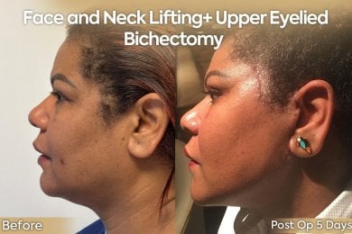 before-after photo endoscopic-facelift