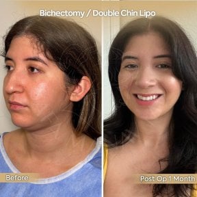 before-after photo endoscopic-facelift