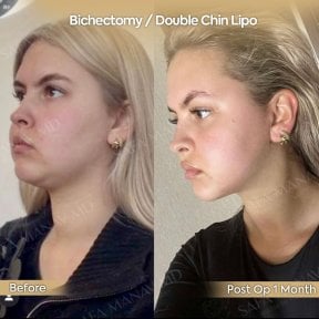 before-after photo endoscopic-facelift