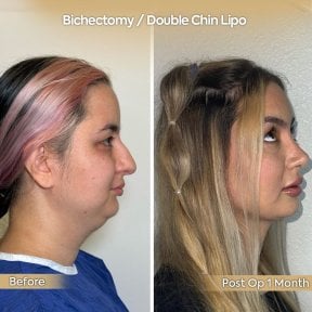 before-after photo endoscopic-facelift