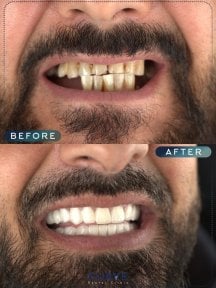 before-after photo dental-implant