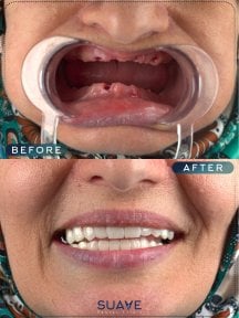 before-after photo dental-crown-installation