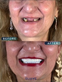 before-after photo dental-crown-installation
