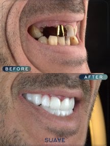 before-after photo dental-crown-installation