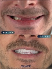 before-after photo dental-crown-installation