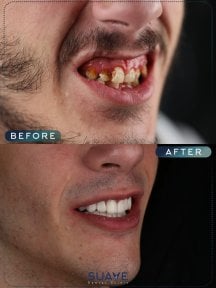 before-after photo dental-implant