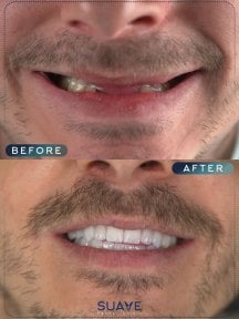 before-after photo dental-implant
