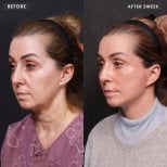 Resultados de lifting facial antes y después en VG Plastic Surgery – rejuvenecimiento facial a 2 semanas